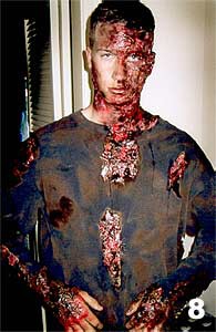 Queimaduras de Terceiro Grau